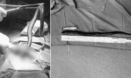 Doctors remove live eel from man's abdomen