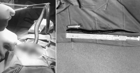 Doctors remove live eel from man's abdomen