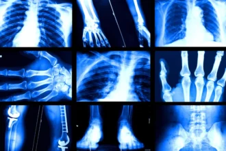 AI models that analyze medical images can be biased