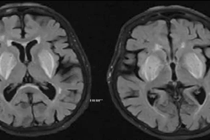 Test predicts future cognitive decline in Alzheimer's