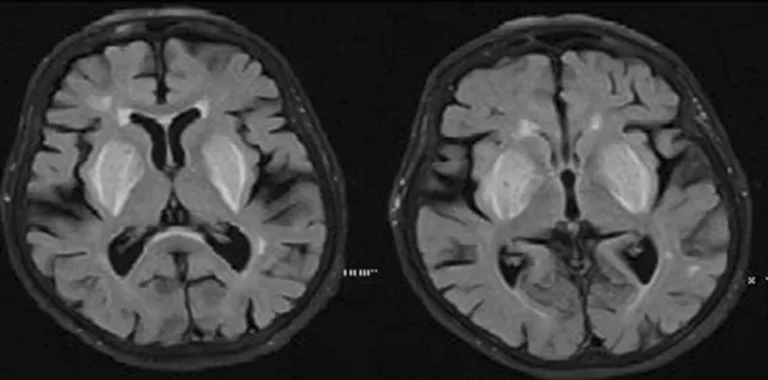 Test predicts future cognitive decline in Alzheimer's
