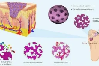 Nova técnica para o tratamento de feridas diabéticas