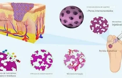 Nova técnica para o tratamento de feridas diabéticas