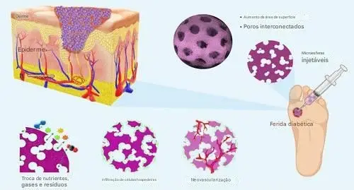 Nova técnica para o tratamento de feridas diabéticas