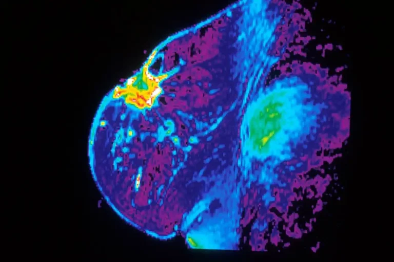 AI could improve early detection of breast cancer