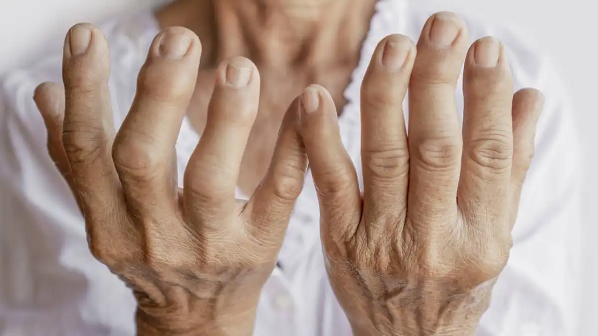 Explaining the link between ‘good’ gut bacteria and rheumatoid arthritis