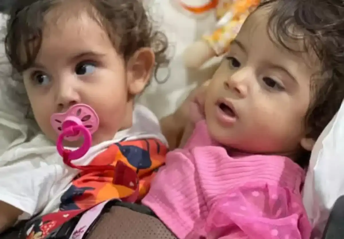 Siamese twins are successfully separated after surgery in Goiânia, Brazil.
