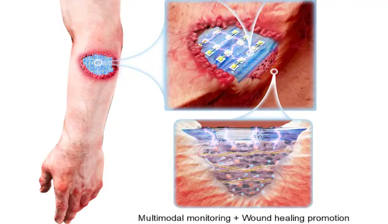 AI device promotes rapid healing of chronic wounds