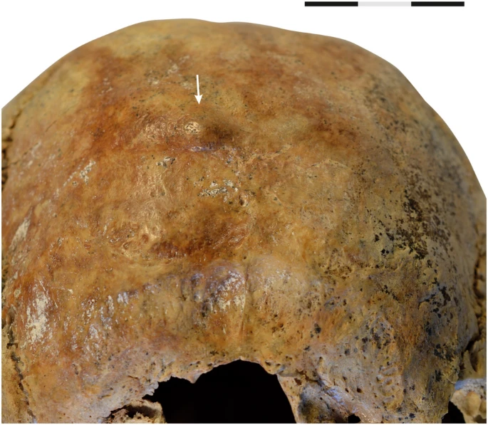 Foto mostrando o pequeno tumor benigno (osteoma) na região occipital de uma das mulheres (H2a)