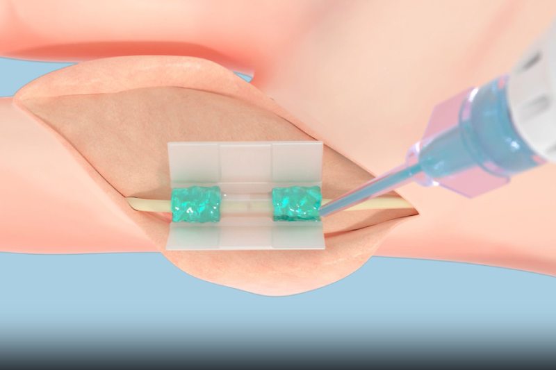 Tissium’s platform consists of biocompatible polymers (the blue, gel-like substance in this rendering) that conform to tissues and a 3D-printed chamber (clear tube at center).