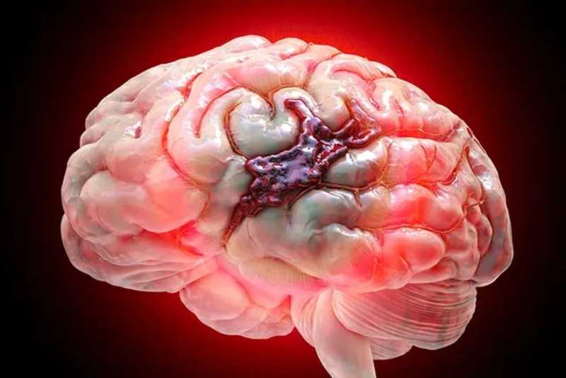 Poluição do ar está associada a maior risco de hemorragias cerebrais