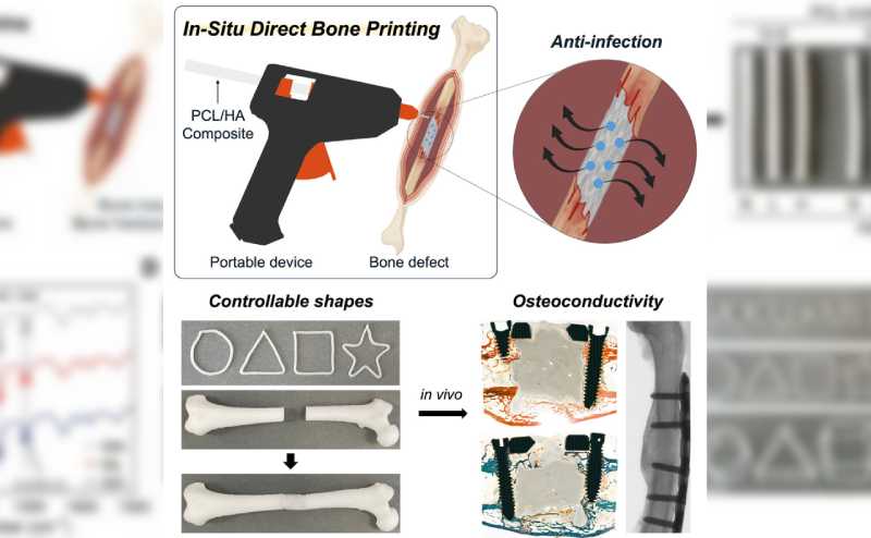 Impressora portátil cria implantes biodegradáveis para regenerar ossos