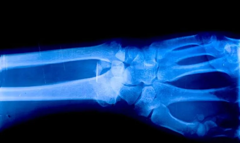 Microplásticos encontrados profundamente dentro dos ossos humanos