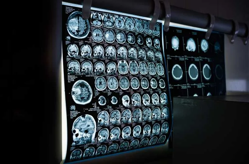 MIT researchers have developed a new AI-based tool that rapidly annotates areas of interest in medical images and can help in the study of new treatments or map disease progression.