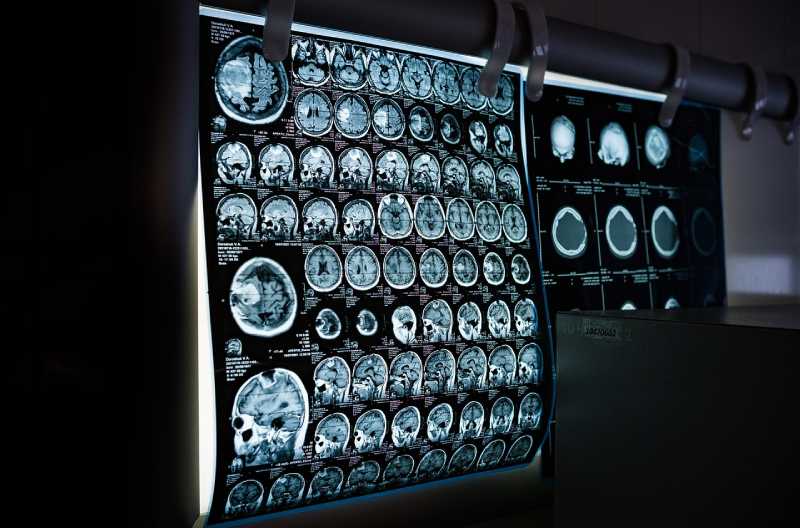 Pesquisadores do MIT desenvolveram uma nova ferramenta baseada em IA que anota rapidamente áreas de interesse em imagens médicas, podendo auxiliar no estudo de novos tratamentos ou no mapeamento da progressão de doenças. Crédito da imagem: Mitrey/Pixabay