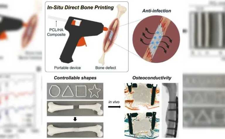 Portable printer creates biodegradable implants to regenerate bones
