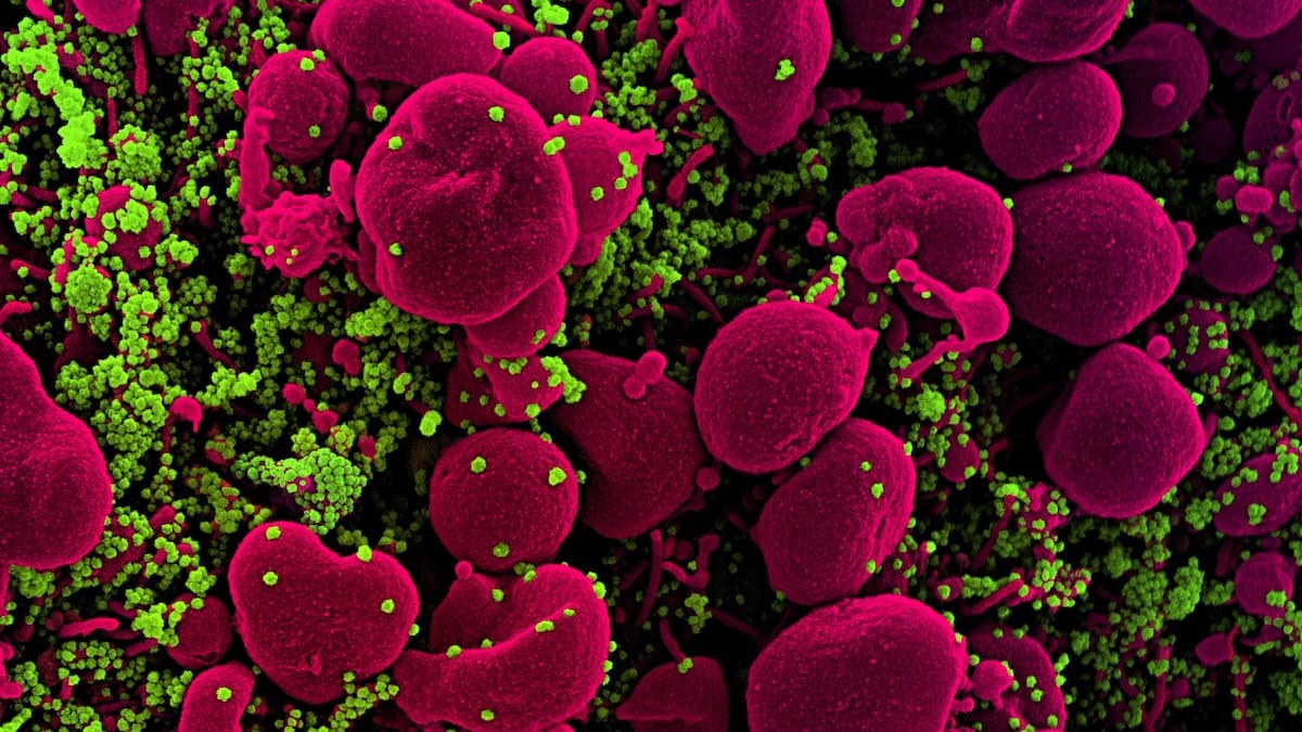 Micrografia eletrônica de varredura colorizada de uma célula apoptótica (rosa) fortemente infectada por partículas do vírus SARS-CoV-2 (verde), isolada de uma amostra de paciente. (Instituto Nacional de Alergia e Doenças Infecciosas/NIH/Flickr/domínio público)