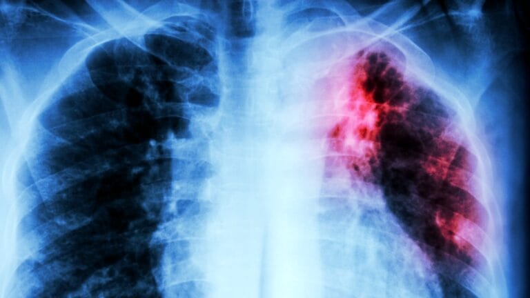 Nova Descoberta Científica Traz Esperança na Luta Contra a Tuberculose Resistente