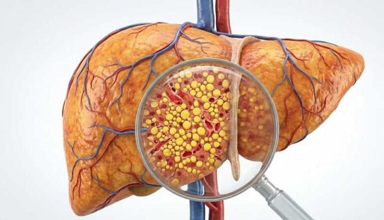Um acúmulo de células imunológicas "zumbis" disfuncionais pode ser um dos principais fatores do envelhecimento e da doença hepática gordurosa. A remoção dessas células em camundongos reverteu danos ao fígado, mesmo sem alterar uma dieta não saudável.