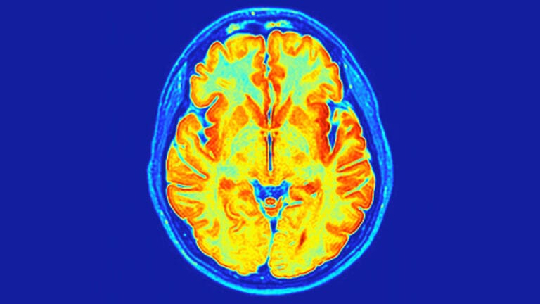 Cientistas Identificam Novo Transtorno Neurodesenvolvimental em Nossos Genes