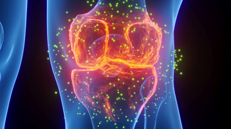 Medicamentos Comuns para Gota Associados a Menor Risco de Infarto e AVC