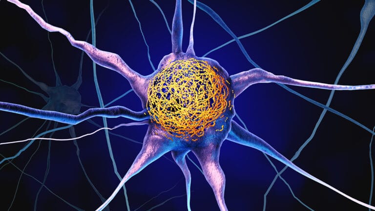 Pesquisa Indica Que Vitamina D Pode Reduzir Acúmulo de Proteínas Associadas ao Alzheimer