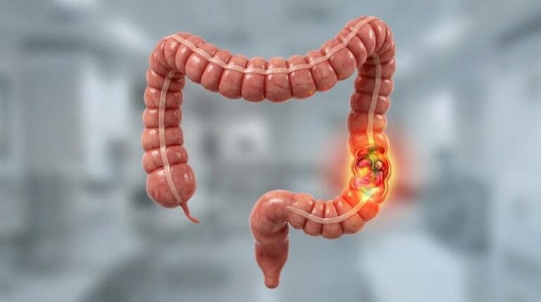 Um vírus recém-identificado dentro de bactérias intestinais está fortemente ligado ao câncer colorretal, oferecendo uma nova e surpreendente pista sobre a doença. A descoberta sugere que vírus dentro de micróbios—não apenas os micróbios em si—podem desempenhar um papel crítico.