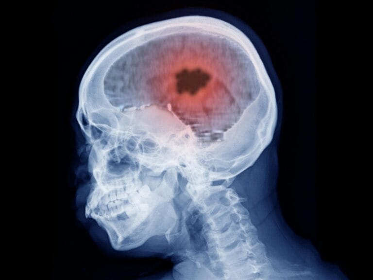 Pesquisa revela terapia com vitamina B12 para câncer cerebral