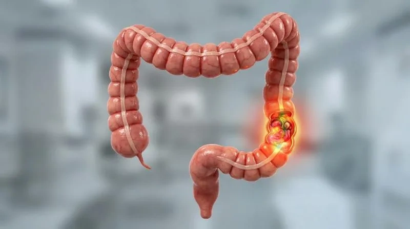 O câncer colorretal está aumentando em adultos mais jovens a um ritmo alarmante, com alguns pacientes sendo diagnosticados na casa dos trinta anos, apesar de não terem histórico familiar da doença.