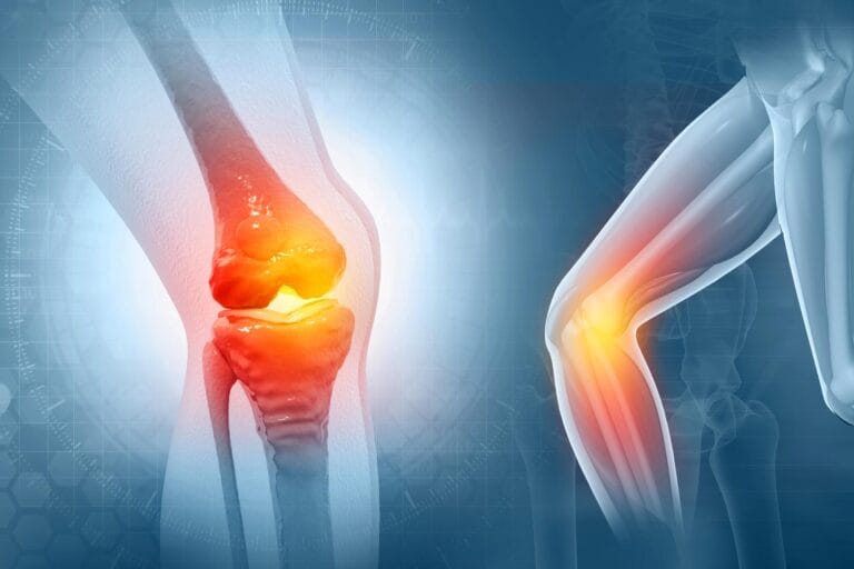 Pesquisadores desenvolvem tratamento inovador para osteoartrite