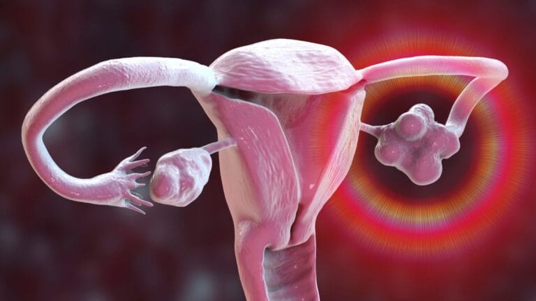 PCOS é renomeado para síndrome metabólica ovariana