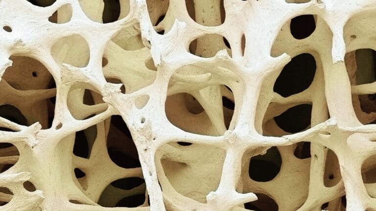 Osteopenia afeta 40% dos adultos e pode indicar osteoporose