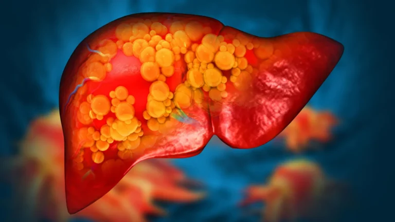 Novo medicamento pode combater doença hepática gordurosa