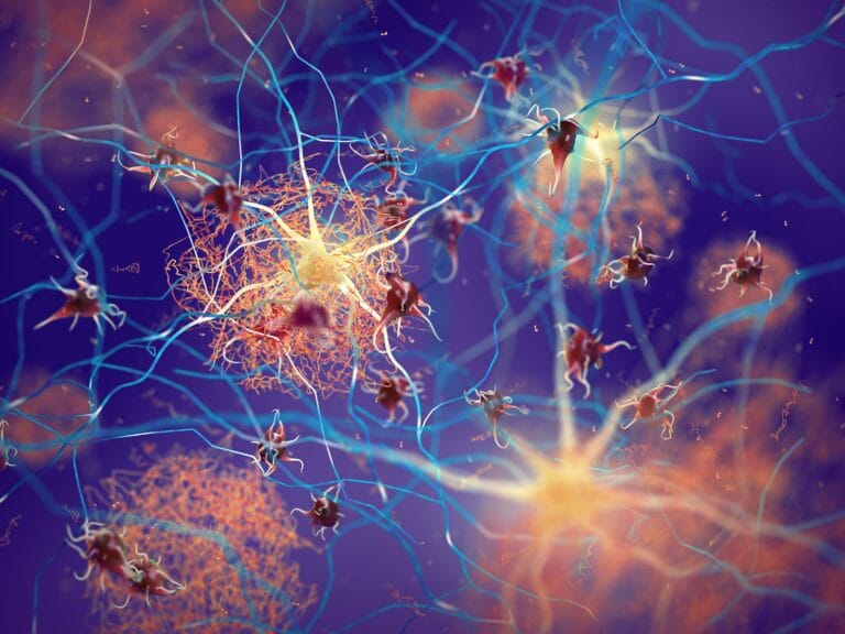 Estudo identifica ponto crucial na progressão do Alzheimer