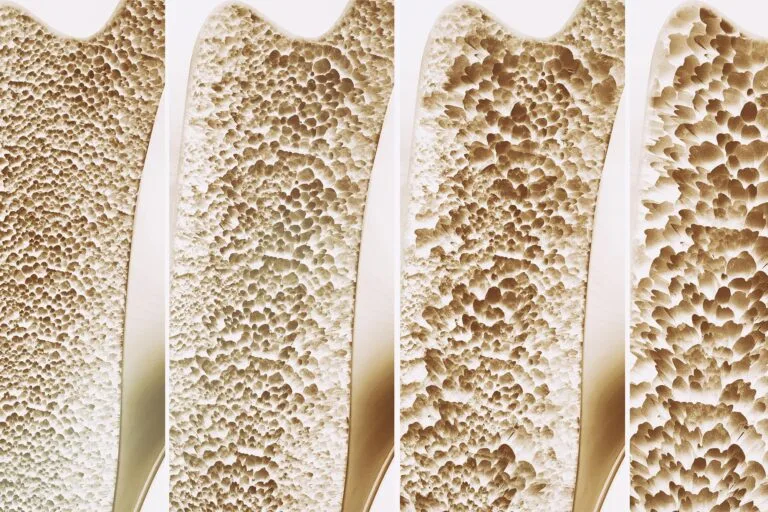 Estudo revela papel da vitamina K na prevenção da perda óssea