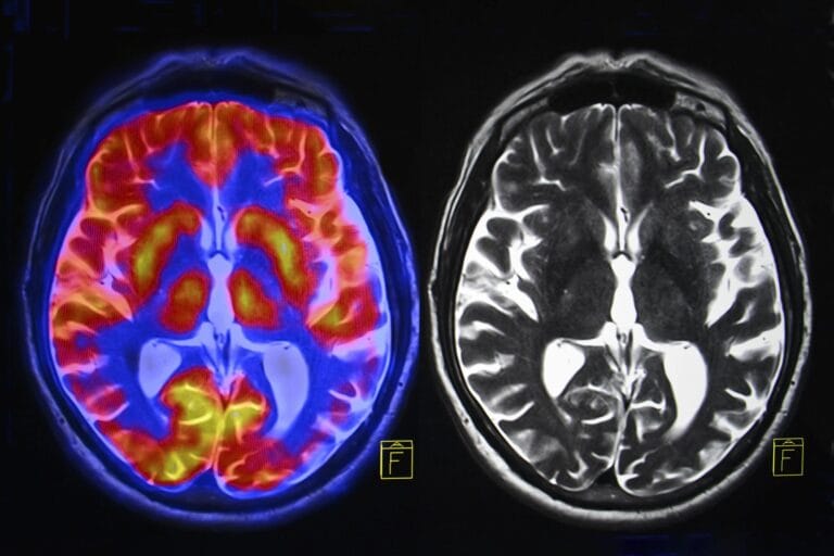 Estudo aponta que long COVID não é causado por inflamação cerebral
