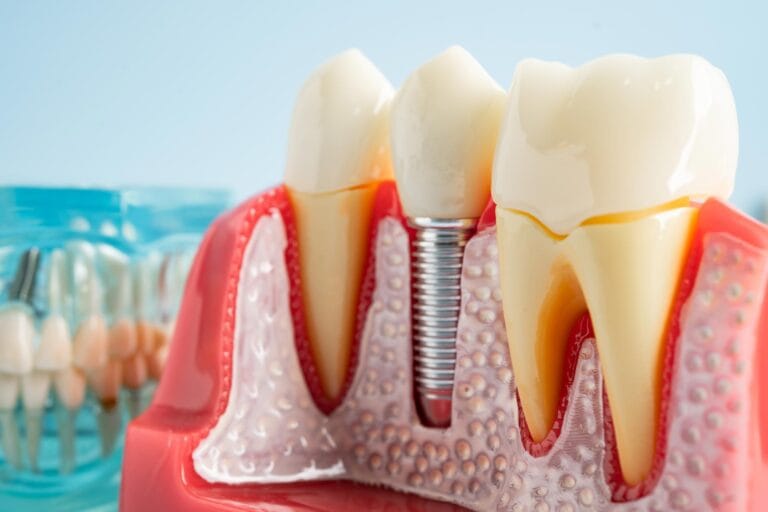 Pesquisa revela causa de infecção em implantes dentários