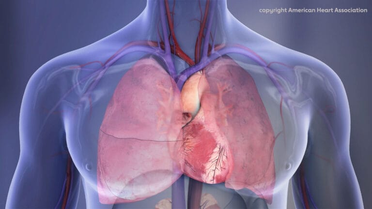 Bactéria bucal pode causar calcificação da válvula aórtica