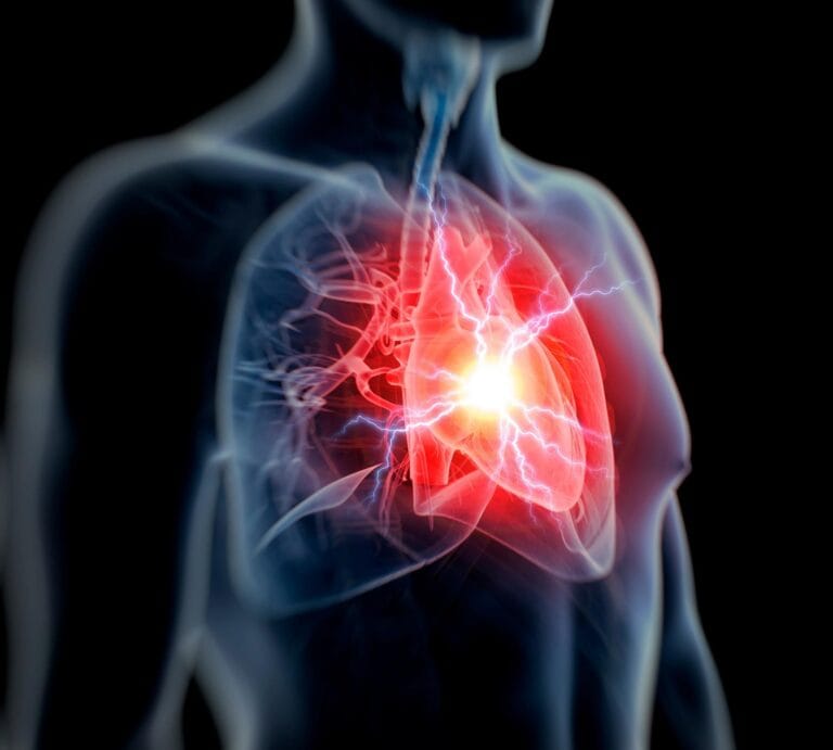 Microplásticos detectados em 84% de pacientes com infarto