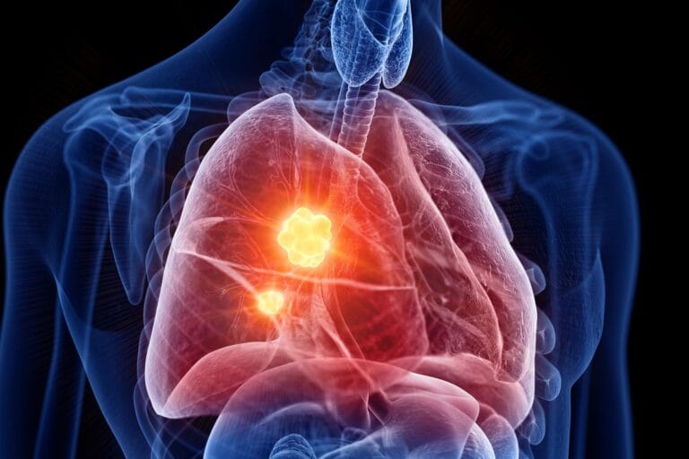 Universidade de Vermont desenvolve novo tratamento para mesotelioma
