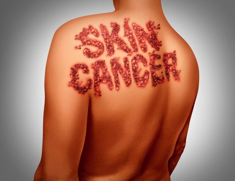 Estudo identifica mais de 250 genes relacionados ao melanoma
