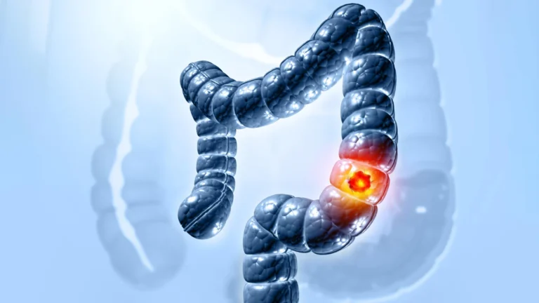 Pesquisa revela como bactéria intestinal provoca câncer de cólon