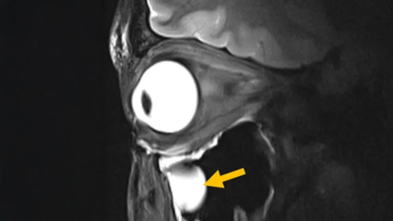Nova antena de MRI melhora imagens do cérebro e olho