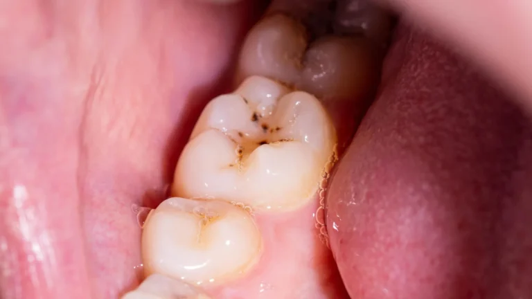 Universidade de Nottingham desenvolve gel para regenerar esmalte dental