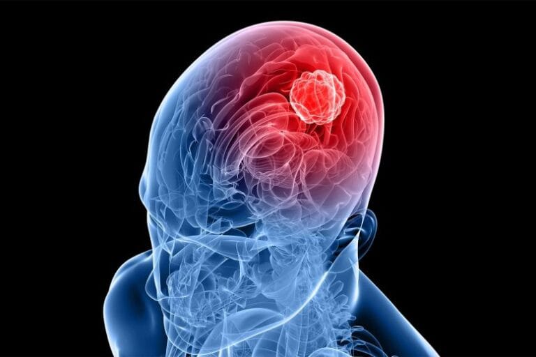 Pesquisadores identificam proteína que pode ajudar no tratamento do glioblastoma