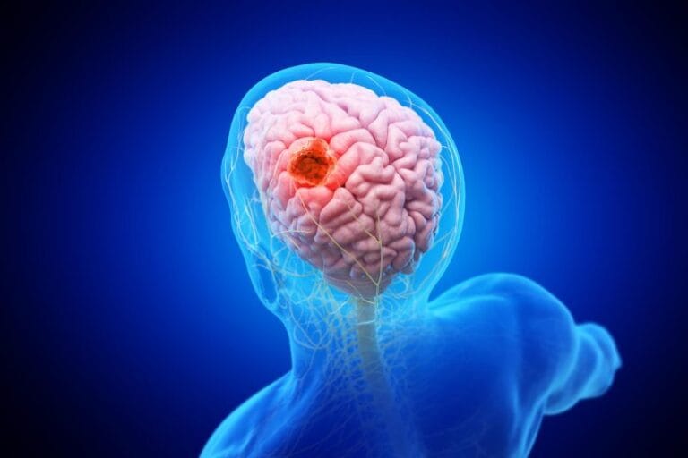 Nanopartículas ativadas por luz podem combater glioblastoma