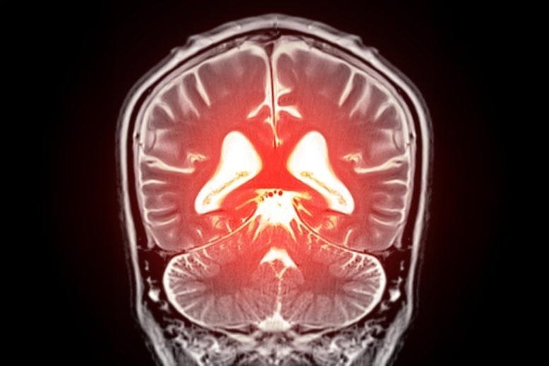 Dementia Diagnostics MRI Brain Scan