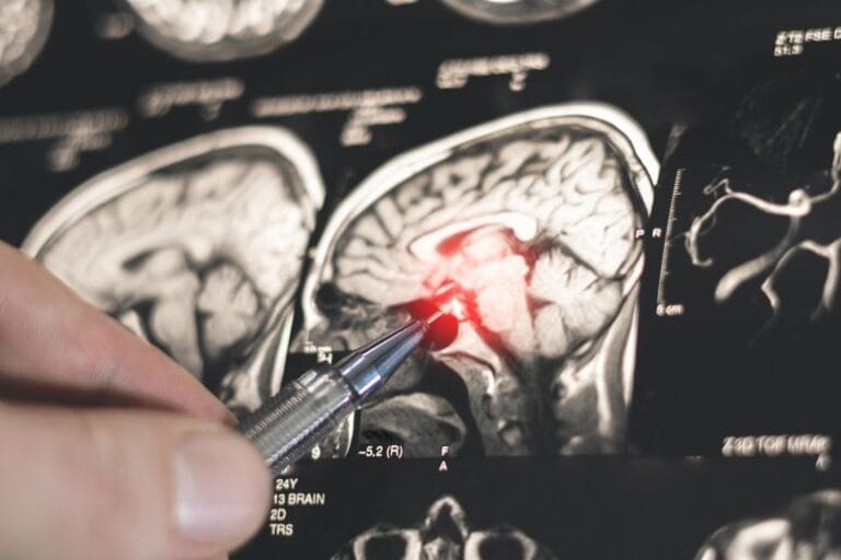 Estudo relaciona sono e memória em pacientes com epilepsia