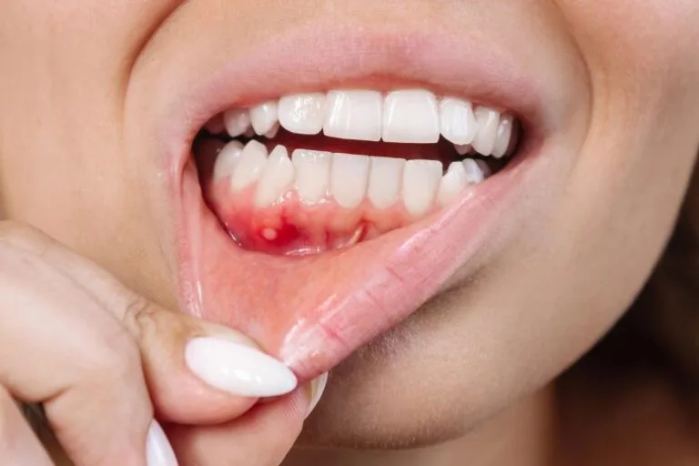 Estudo aponta benefícios de suplementos contra periodontite severa