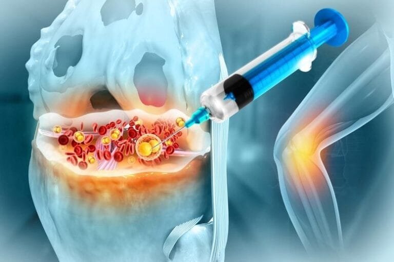 Lacosamida mostra potencial no tratamento da osteoartrite